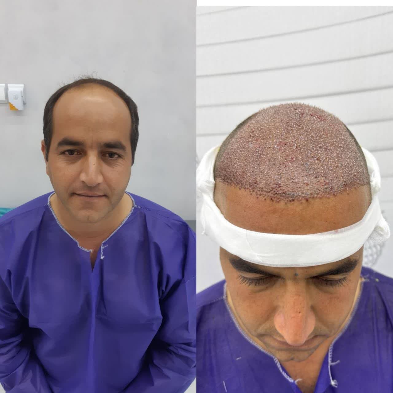 نمونه کاشت مو ۱