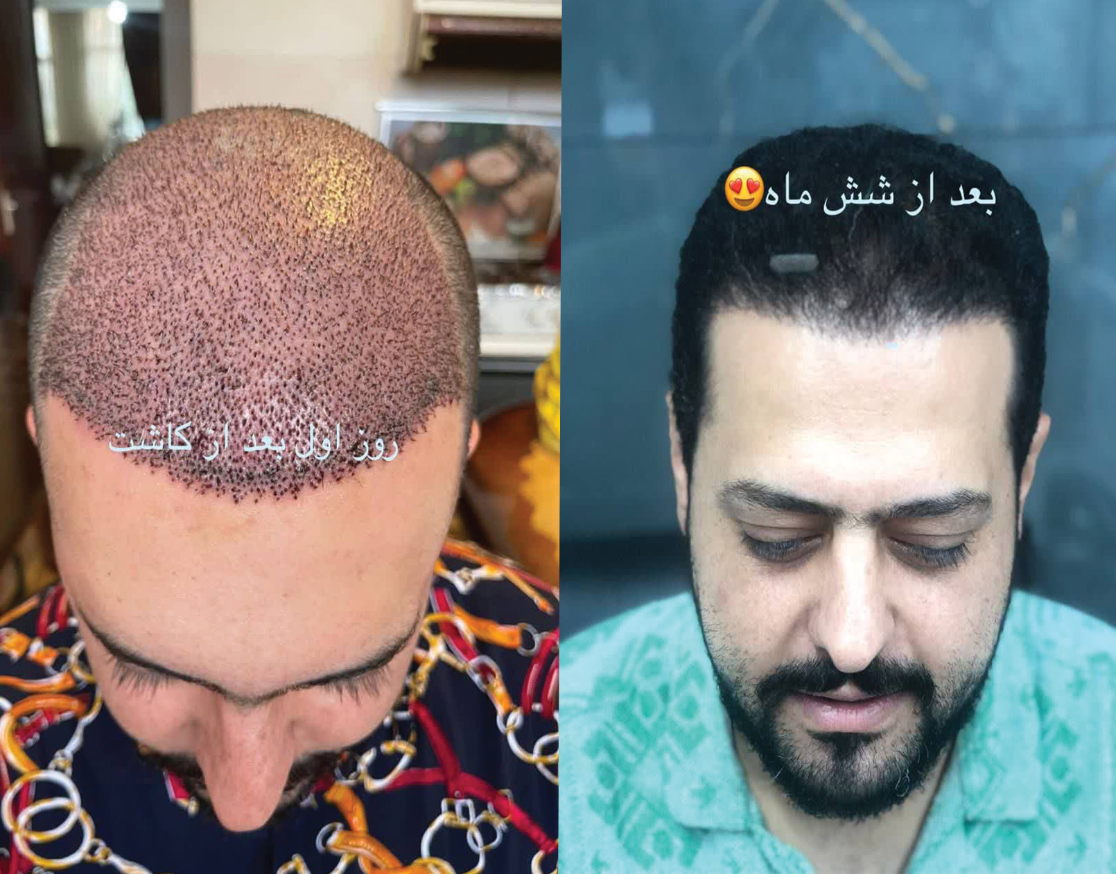 نمونه کاشت مو ۲