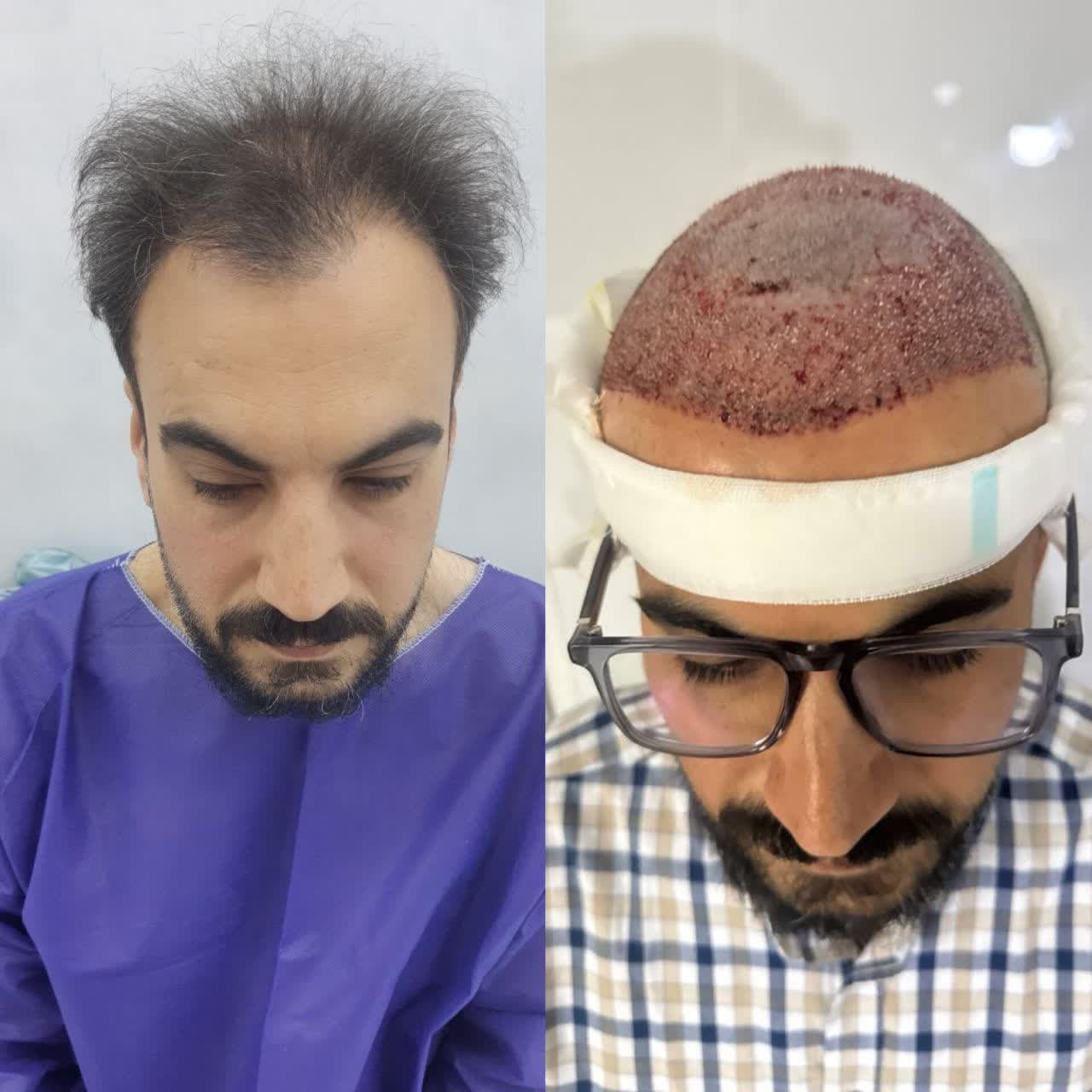 نمونه کاشت مو ۳