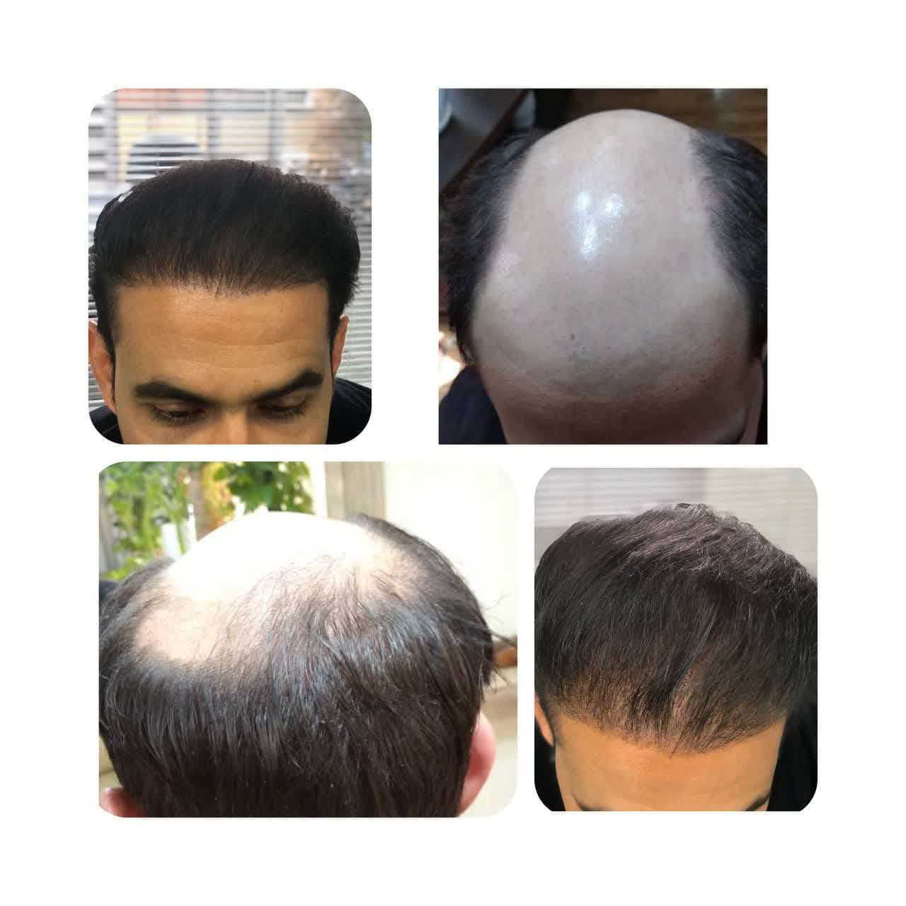 نمونه کاشت مو ۴