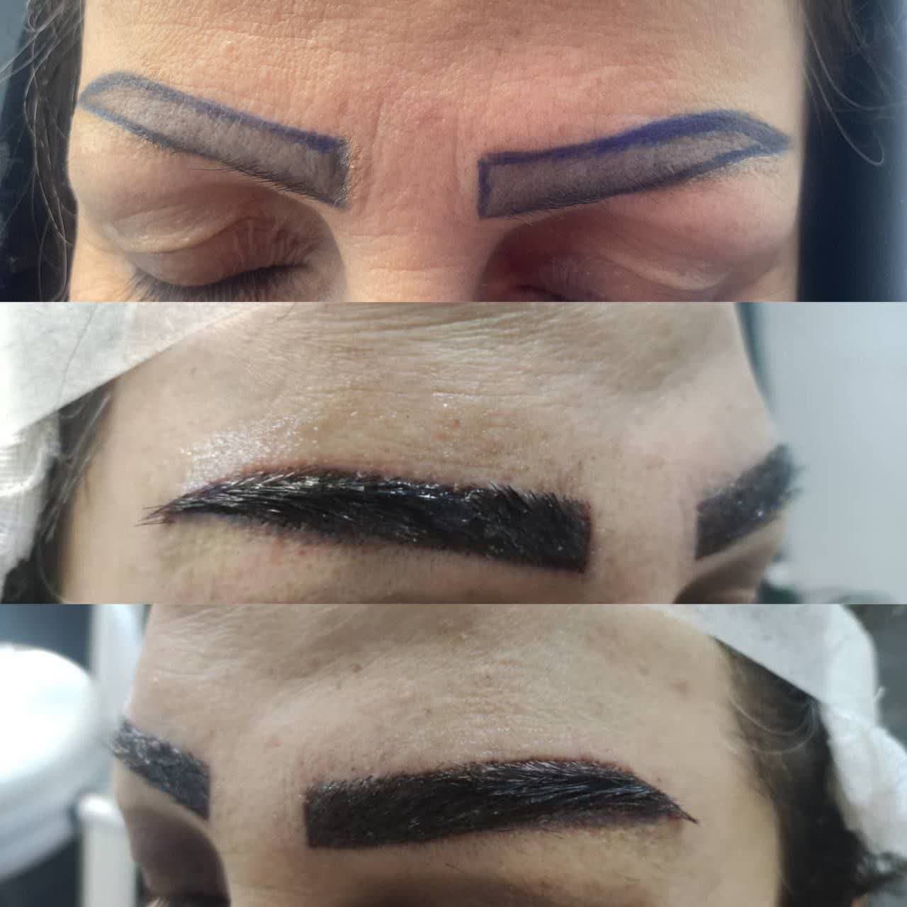 کاشت مو طبیعی