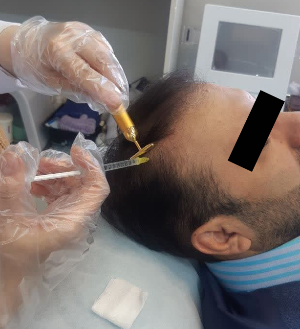 کاشت مو طبیعی